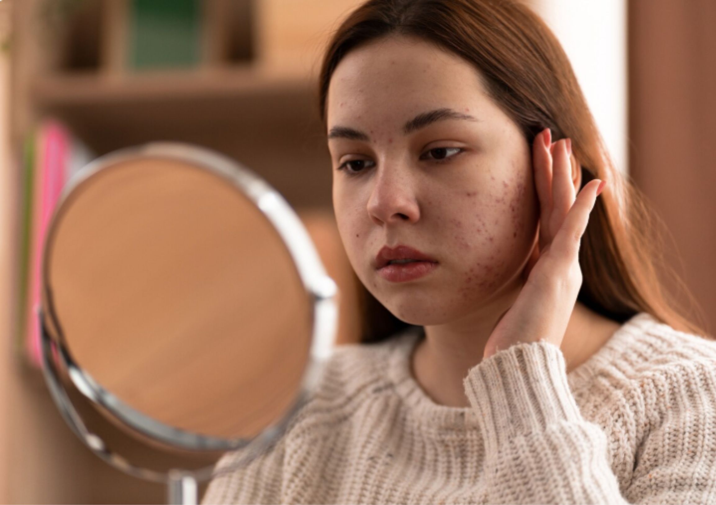 O Zinco é um Aliado Contra a Acne Hormonal?
